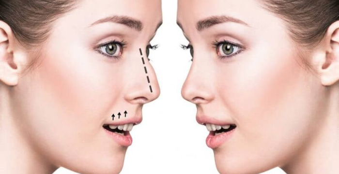 Who Should Consider a Non-Surgical Nose Job - Guide 2025