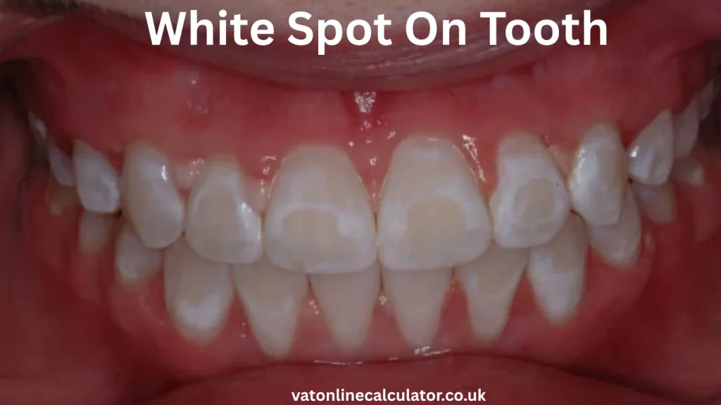 Why Do White Spots Appear on Teeth